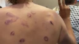 Hematomas e fraturas: ativistas da flotilha falam em tortura em Israel